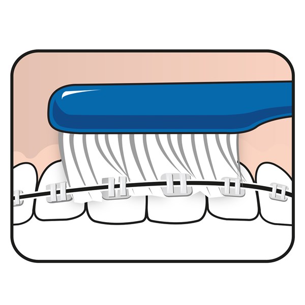 TePe® Implant / Orthontic- Bürste - Nachhaltig
