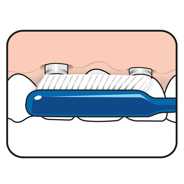 TePe® Implant / Orthontic- Bürste - Nachhaltig